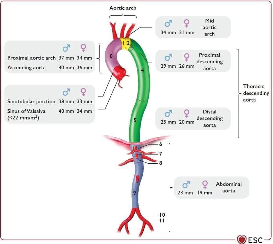 Aorta aneurysm