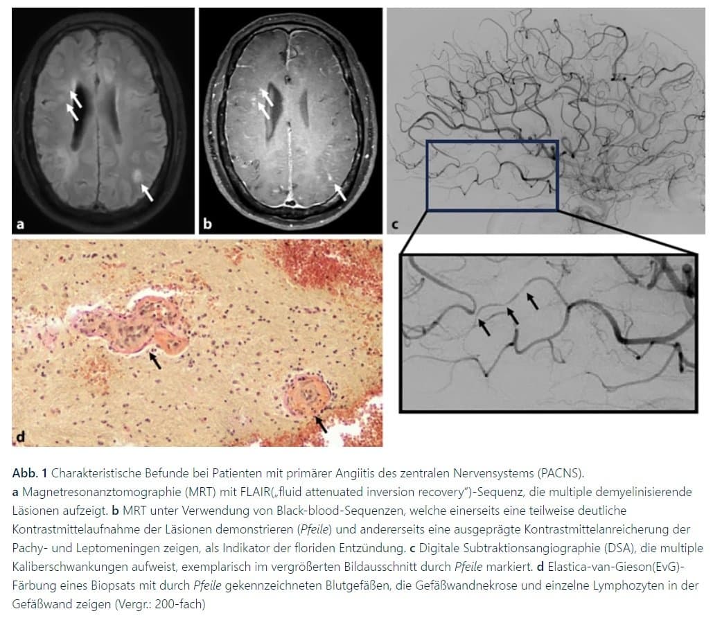 Entzündliche Ursachen von Schlaganfällen – Diagnostik und Therapie ( İşemik İnsultun İltihabi səbəbləri- Diaqnostika və Müalicəsi)
