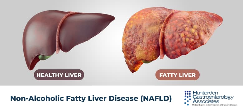 Treatment of Dyslipidemia in Common Liver Diseases ( Qaraciyər xəstəlikləri zamanı Dislipidemiyanın müalicəsi)