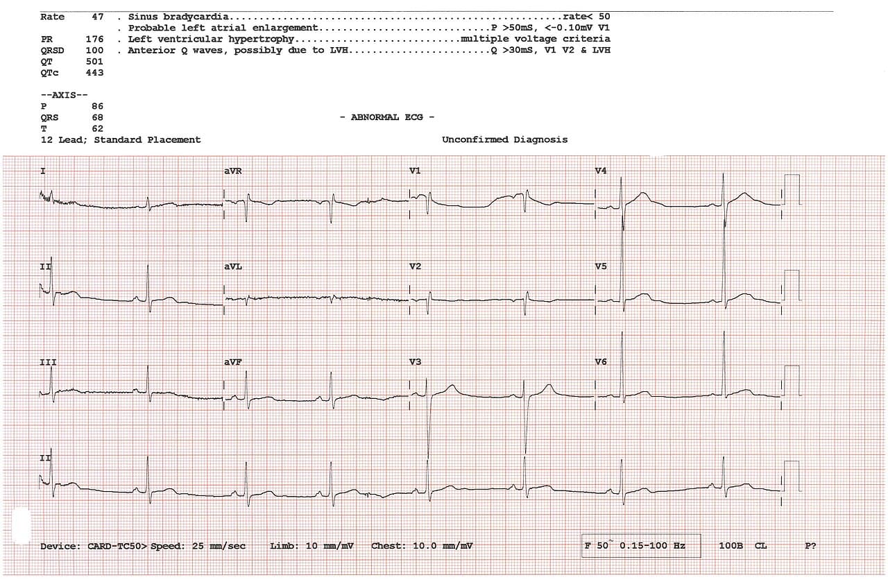 EKG (elektrokardioqrafiya) nədir və nə göstərir?